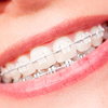 Verringern Zahnspangen das Risiko einer Nickelallergie?