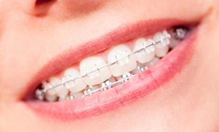 Nickel in Zahnspangen – erhöhte Allergiegefahr?