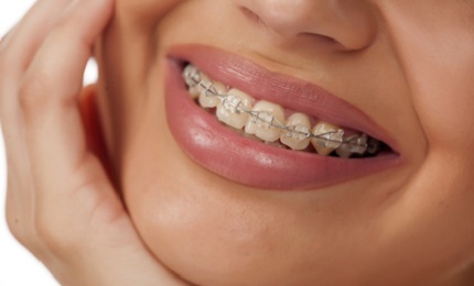 Zahnspange bei Nickelallergie – auf nickelfreie Materialien bestehen!